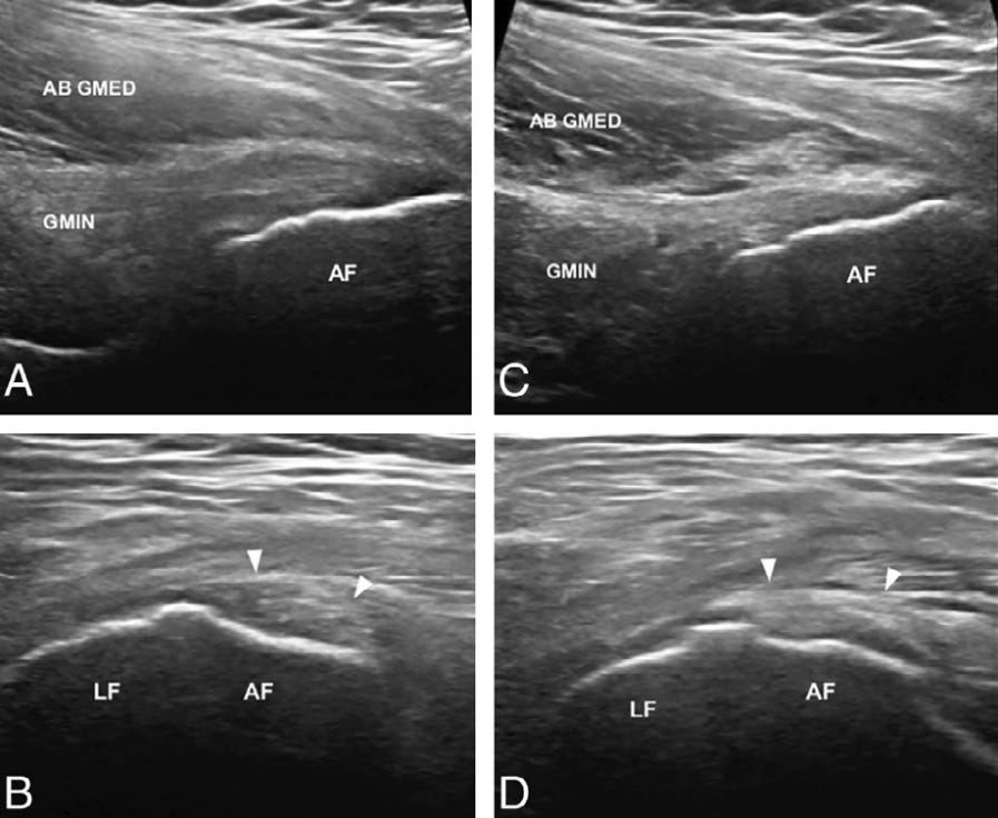 Gluteo menor 1 ecografia tempo formacion.jpg